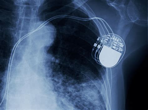 Pacemakers And Implantable Defibrillators Medlineplus
