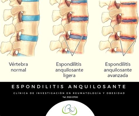 La espondilitis anquilosante es artropatía que afecta principalmente a