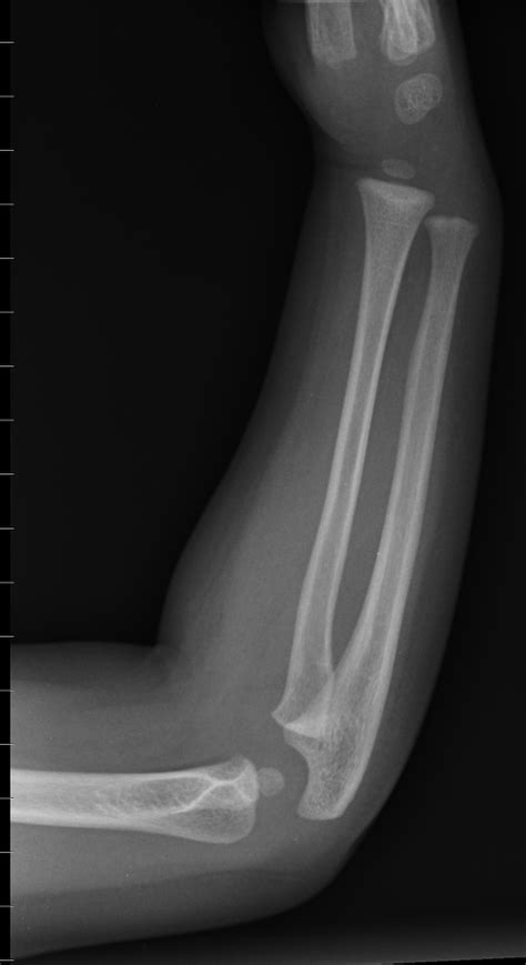 5 Year Old Knee X Ray Tibia Images
