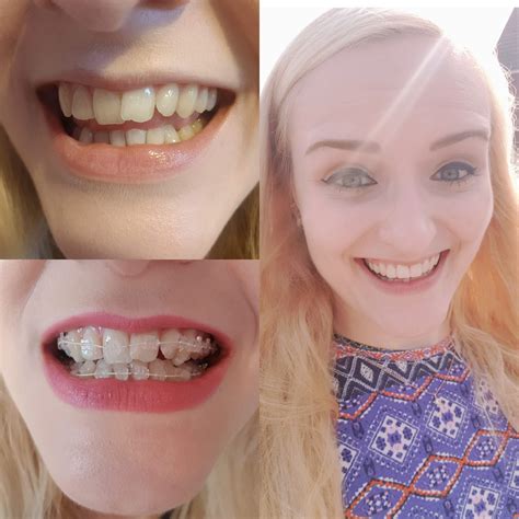 After Dreaming Of Having Straight Teeth For My Whole Life My Adult Braces Are Off After 9