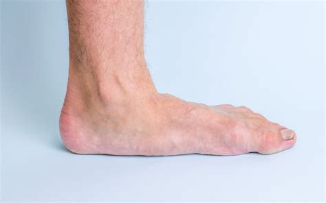 Learn How Dr Kane Can Help Treat Adult Acquired Flatfoot
