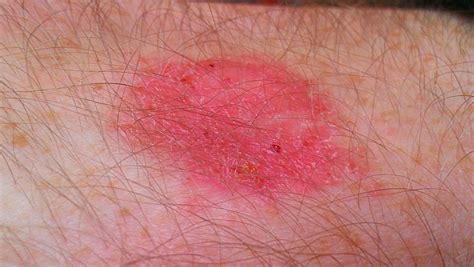 Skin Disease Types Nummular Dermatitis