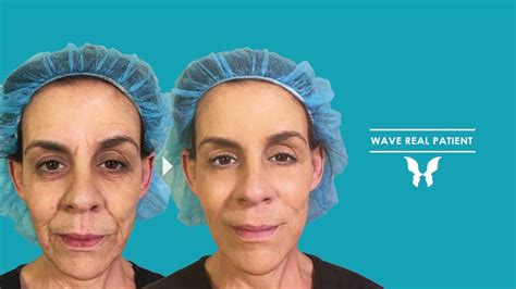 Wave Plastic Surgery Center Antiaging Transformation With Botox