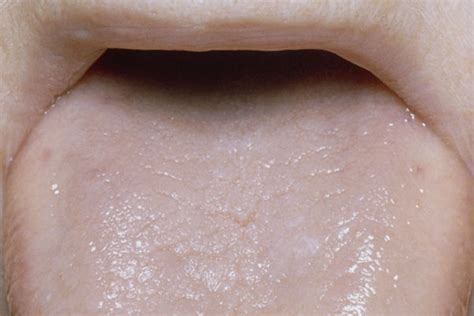 Anemia
