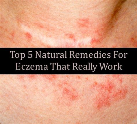 13 Home Remedies To Get Rid Of Eczema That Really Work Natural