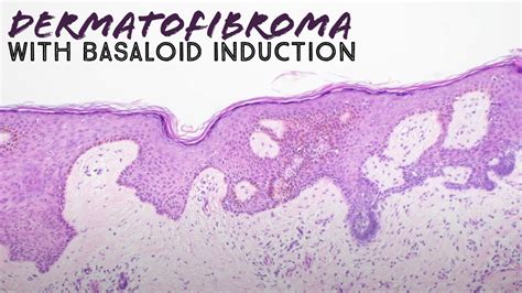 Dermatofibroma With Basaloid Follicular Induction Pathology Mimic Of