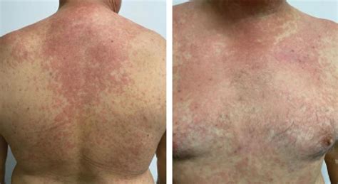 Maculopapular Rashes In Covid 19 Experience Of 14 Cases