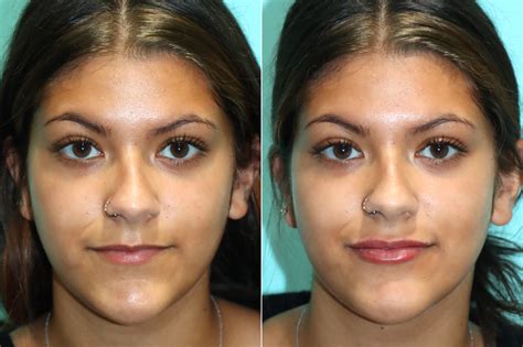 Lip Augmentation Photos Chevy Chase Md Patient 17659