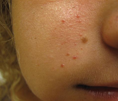 Unilateral Papules On The Face Mdedge Dermatology