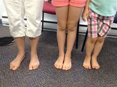 Will My Child Grow Out Of Their Foot Problem Clark Podiatry Center