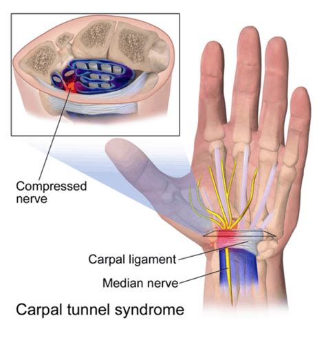 Can Carpal Tunnel Syndrome Be Service Connected For Veterans Va