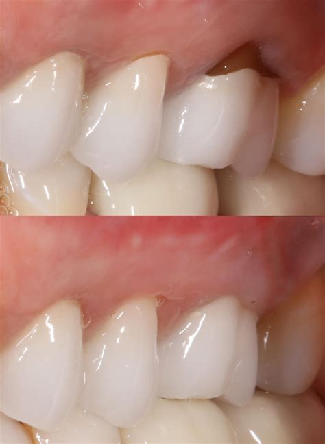 Receding Gums Before And After