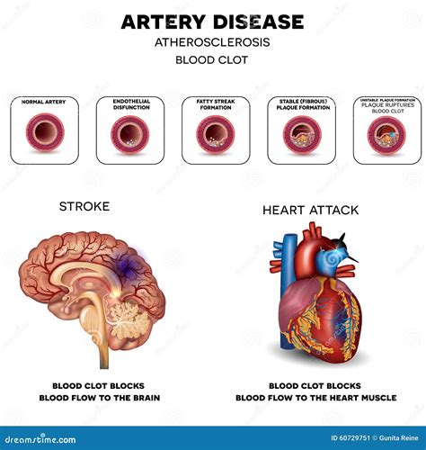 Artery Disease Atherosclerosis Stock Vector Illustration Of Coronary