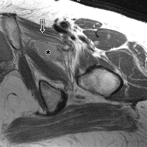 Mr Imaging Of Entrapment Neuropathies Of The Lower Extremity