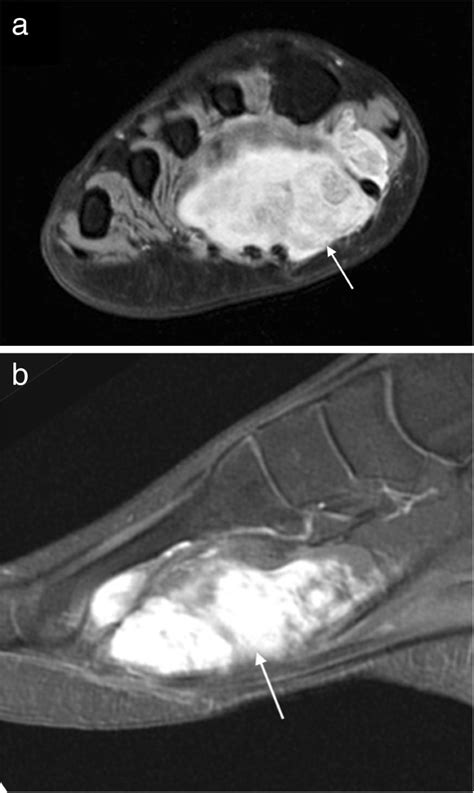 Mri Imaging Of Soft Tissue Tumours Of The Foot And Ankle Insights