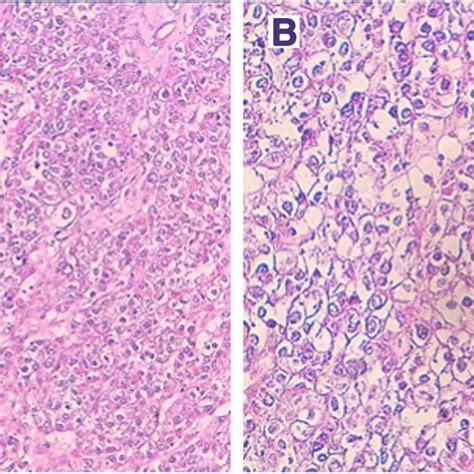 A Uterine Clear Cell Carcinoma With Solid And Trabecular Structures