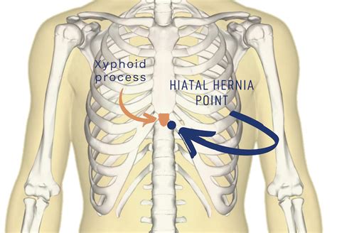 Hiatal Hernia Syndrome Nourishing Therapies