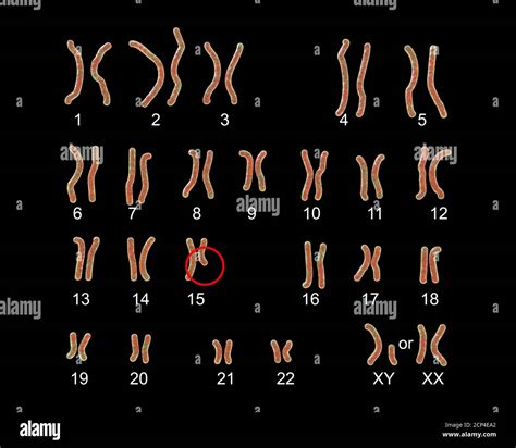 karyotype of prader willi syndrome computer illustration this is a genetic disorder caused by