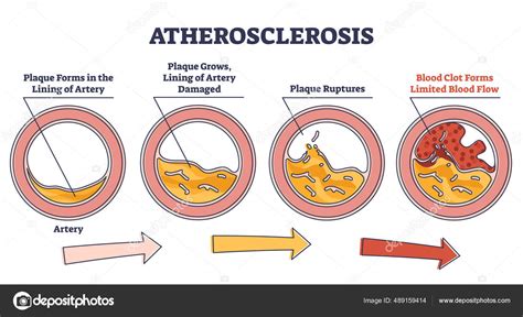 Atherosclerosis Stages Explanation And Fatty Plaque Formation Outline
