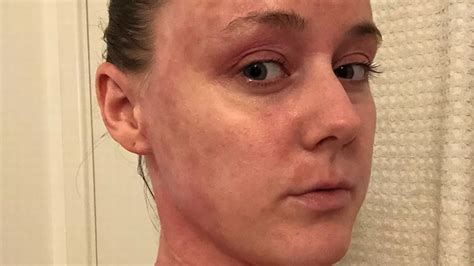 Woman Left With Oozing Skin That Smelt Like Wet Dog After Halting