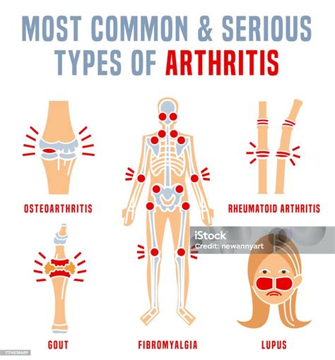 Arthritis Types Infographic Stock Illustration Download Image Now