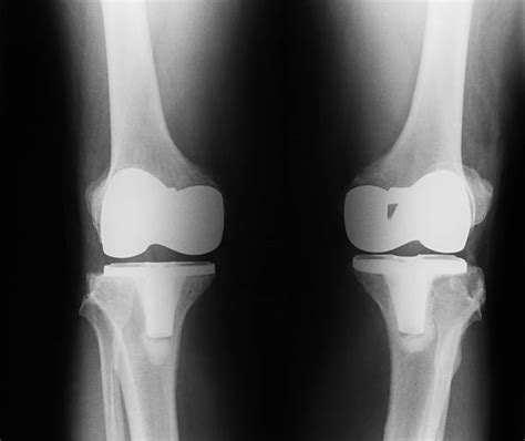 Total Hip Replacement Stock Photos Pictures And Royalty Free Images Istock