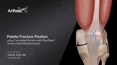 Arthrex Patella Fracture Fixation Using Cannulated Screws With