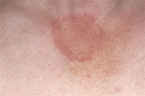 Skin Fungal Infection Pictures Fungal Infection Definition Symptoms