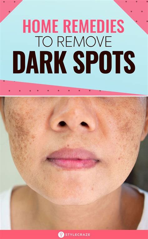 How To Remove Dark Spots On Face Fast 6 Home Remedies