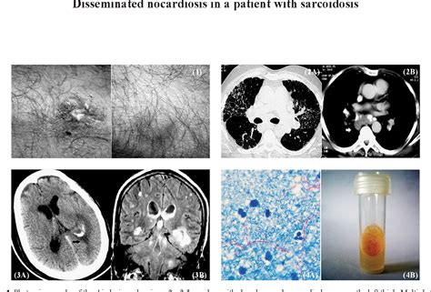 Figure 1 From Disseminated Nocardiosis In A Patient With Sarcoidosis