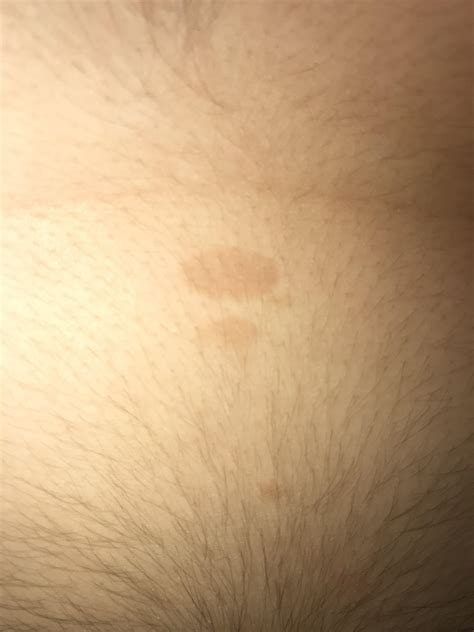 Ive Noticed These Brownish Spots Appearing On My Stomach And Chest