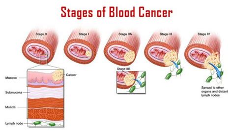 Blood Cancer Causes Stages Diagnosis And Treatment — Medipulse Best