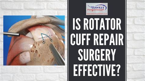 Is Rotator Cuff Repair Surgery Effective Hawkes Physiotherapy