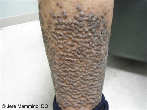 Lichen Amyloidosis American Osteopathic College Of Dermatology Aocd