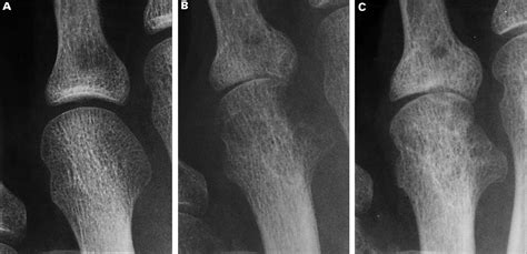 Healing Of Erosions In Rheumatoid Arthritis Annals Of The Rheumatic