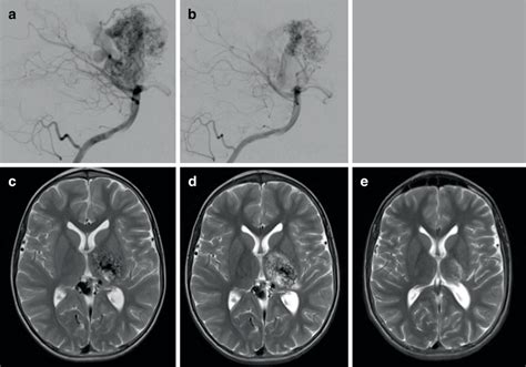 The Angiographic Appearances Pre Embolization A And Post Multiple