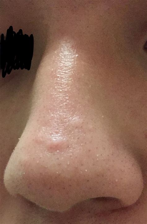 Raised Scar On Nose How Can I Get Rid Of Itw Pics Scar Treatments Forum