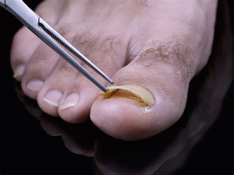The Podiatry Detached Lifted Nails