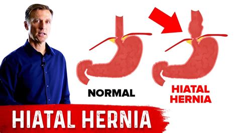 Hiatal Hernia The Best Home Treatment Youtube