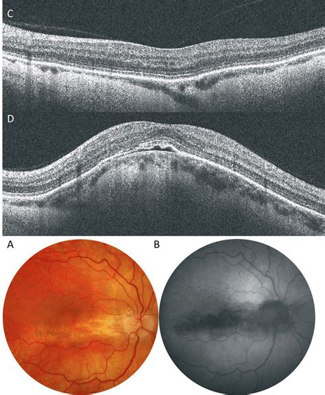 Horizontal Dome Shaped Macula Dsm Fundus Photography A And Fundus