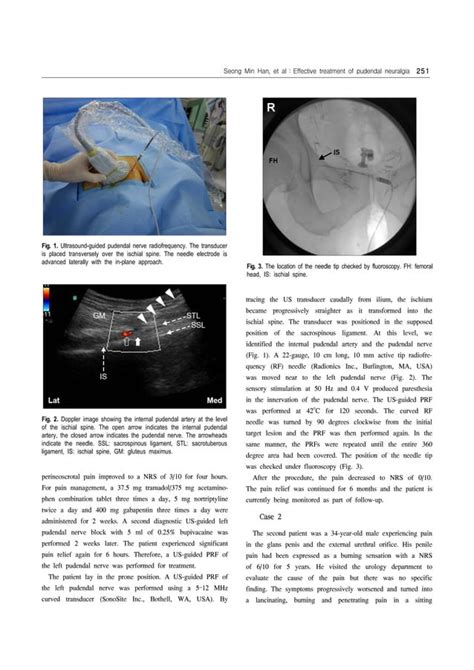 Ultrasound Guided Pudendal Nerve Pulsed Radiofrequency In Patients With