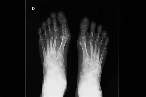 Rheumatoid Arthritis Pictures Symptoms In The Joints