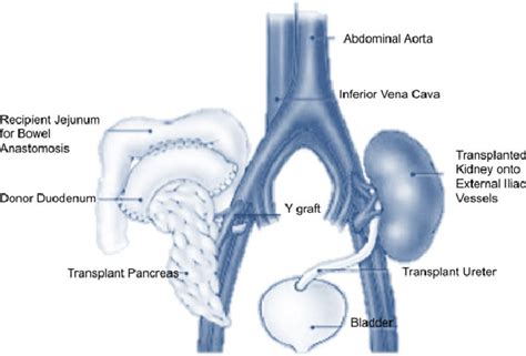 Anatomical Diagram Showing The Placement Of Pancreas And Kidney For A
