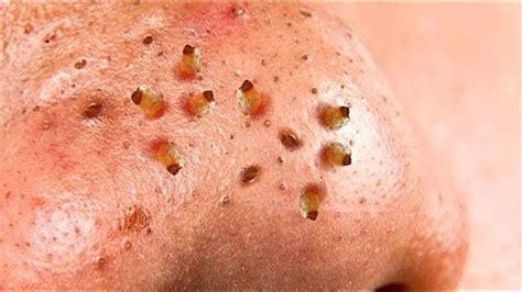 How Are Blackheads Formed Blackheads Removal New Pimple Popping