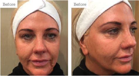 Welcome to our hair consultation column. Case Study: Treating the Mid-face and Jowls - Aesthetics