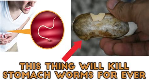 Get Rid Of Stomach Worms At Home Intestinal Worms Home Remedies Youtube