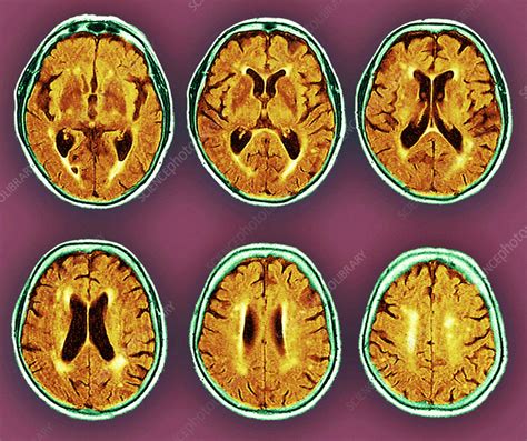 Dementia Mri Scans Stock Image M Science Photo Library