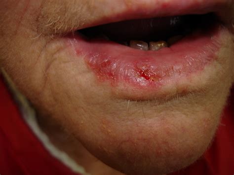 There is a high incidence of second primary skin malignancies in patients with lip carcinoma due to the common sun exposure risk. Dermatology For Dentists and Dental Students: Lips