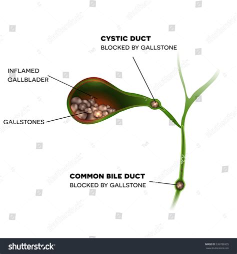 Gallstones Gallbladder Cystic Duct Common Bile Stock Vector Royalty