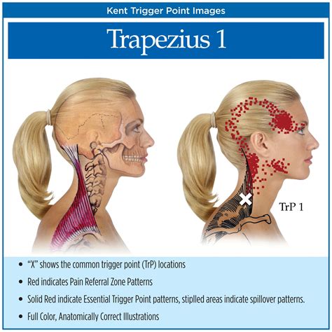 Symptoms Of Myofascial Pain Myofascial Trigger Points Chart